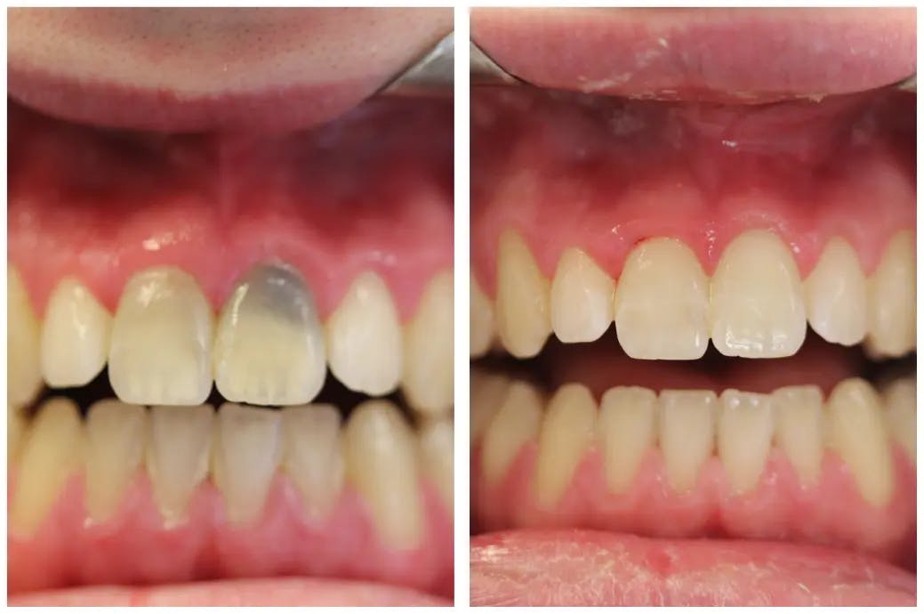 Patient receiving single tooth internal bleaching